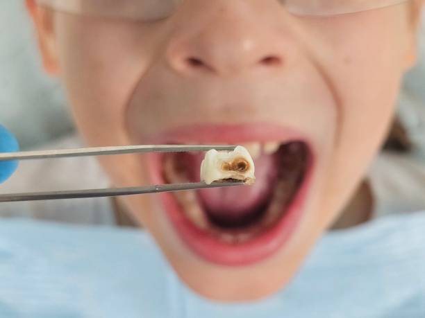 Best Emergency Root Canal Treatment in Cleora, OK